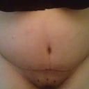 I guess this is what people are calling "swell hell"! very very swollen!
Post Op Day 11 Just had my last drain removed and close up of my scar