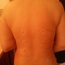 POD 7: look at all the lipo sites! Stuck to mid body but may need to lipo armpits.and no bruising!