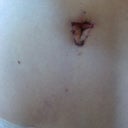 POD 10: my triangular BB. I hope it heals ok right now it looks strange and there are sutures at the top so I hope I don't get the traditional suture scarring. The faint dot above is where the stem is so I thing the idea is that it will retract and become circular.