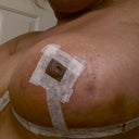 7 days Post Op, bruising! Hoping the Arnica is helping