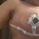 7 days post op, ton of swelling on the sides where drains were ;( looks like side boobage