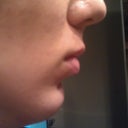 2 moths after surgery
