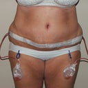 3 Day Post Op, Front (2)