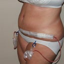 3 Day Post Op, Side (2)