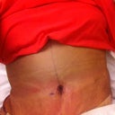 3 days po. I have a bulge over my belly button. and some rolls on one side. last shape on my left side. Don't know if this is suppose to by normal