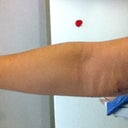 Post Op 4 days