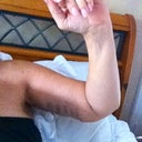 Post Op 12 Days What a difference!
