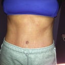 7.5 weeks post op 

Starting to get the definition i've always wanted in my stomach muscles!  6 pack here i come!