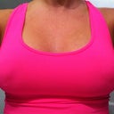 Front view after (lumpy look due to tape on nipples)