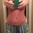 Tummy tuck 3/12