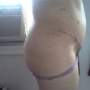 2 WEEKS POST OP