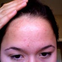 Clearer skin