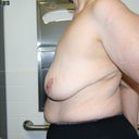 Dec. 06, 2010 Left arm Lipoma