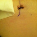 Two days post op
