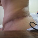 9.5 weeks post op