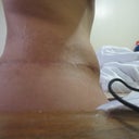 9.5 weeks post op