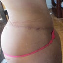 4 months post op