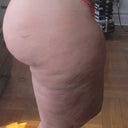 4 months post op
