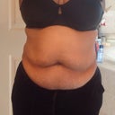 Pre op front view