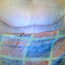incision taken 3/24/11