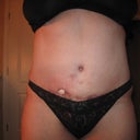 11 weeks post-op as you can see I am healing up nicely and the wound has gotten much smaller it is still about 3 inches deep but I keep my finger's crossed that on Feb 29 when I go back in the PS can fix it