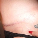 11 weeks post-op