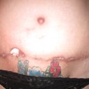 11 weeks post-op as you can see I am healing up nicely and the wound has gotten much smaller it is still about 3 inches deep but I keep my finger's crossed that on Feb 29 when I go back in the PS can fix it