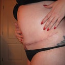 11 weeks post-op