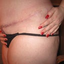 11 weeks post-op