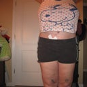 11 weeks post-op