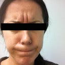 Before botox, in the clinic.