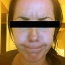 6 days later, I'm already satisfied and it could get a little better in the next 4 days according to the doctor.