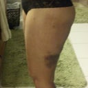 side view, swollen