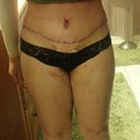 my scar - 12 days post op