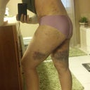 brusing on my legs - 12 days post op