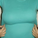Breast augmentation, post op