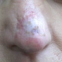 too much restylane was injected & in areas not needed causing necrosis & bumps