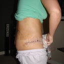 7 days after. Still bruised from Lipo