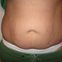2 days before surgery