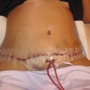 2 days after surgery! Dis not feel as bad as it looked.