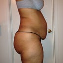 Before the tummy tuck...