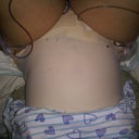 2 days PO laying in bed ( Can't flip this pic sorry)