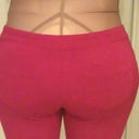 10 days post op