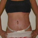 Post Op Day 19