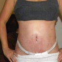 Post Op Day 19