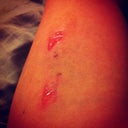The reaction on my arm from a steri strip