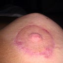 It was after my first aerola lift