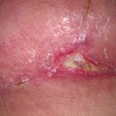 After second surgery