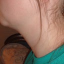 2 Weeks Post - Left Side