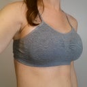 3 days post-op